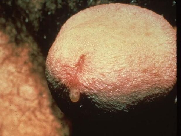 picazón en la uretra debido a la secreción